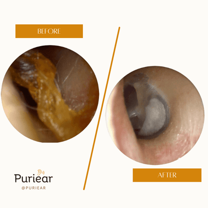 ADVANCED EAR WAX CLEANER™